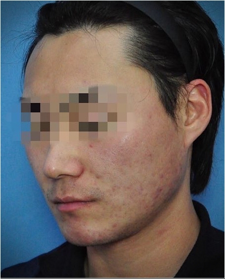 대전지루성피부염 거의 완치 상태