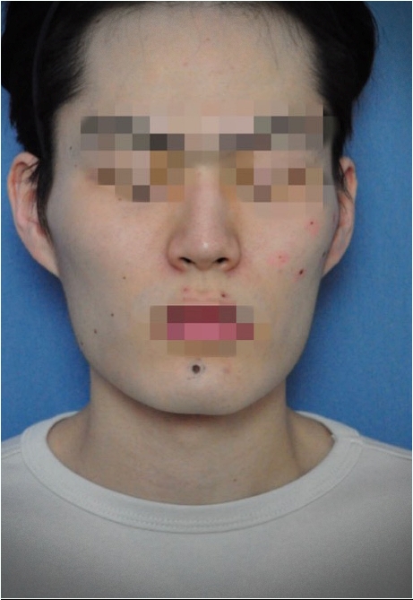 대전점제거 돌출 점 제거 전