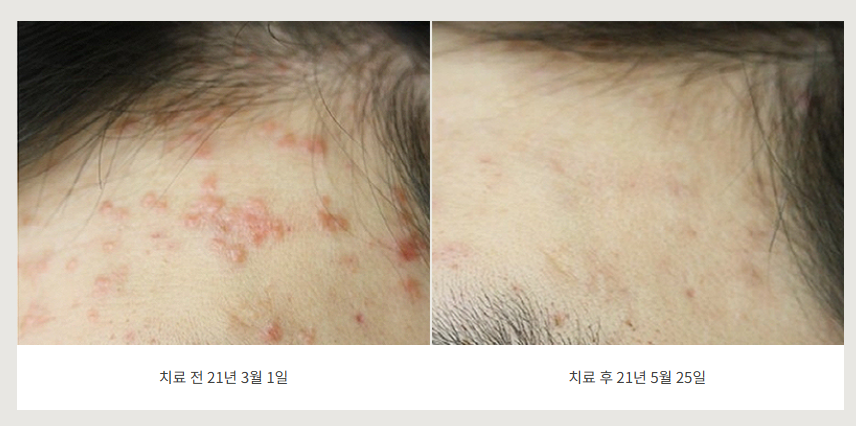 대전 편평사마귀 헤어라인 사율침 치료 전후사진