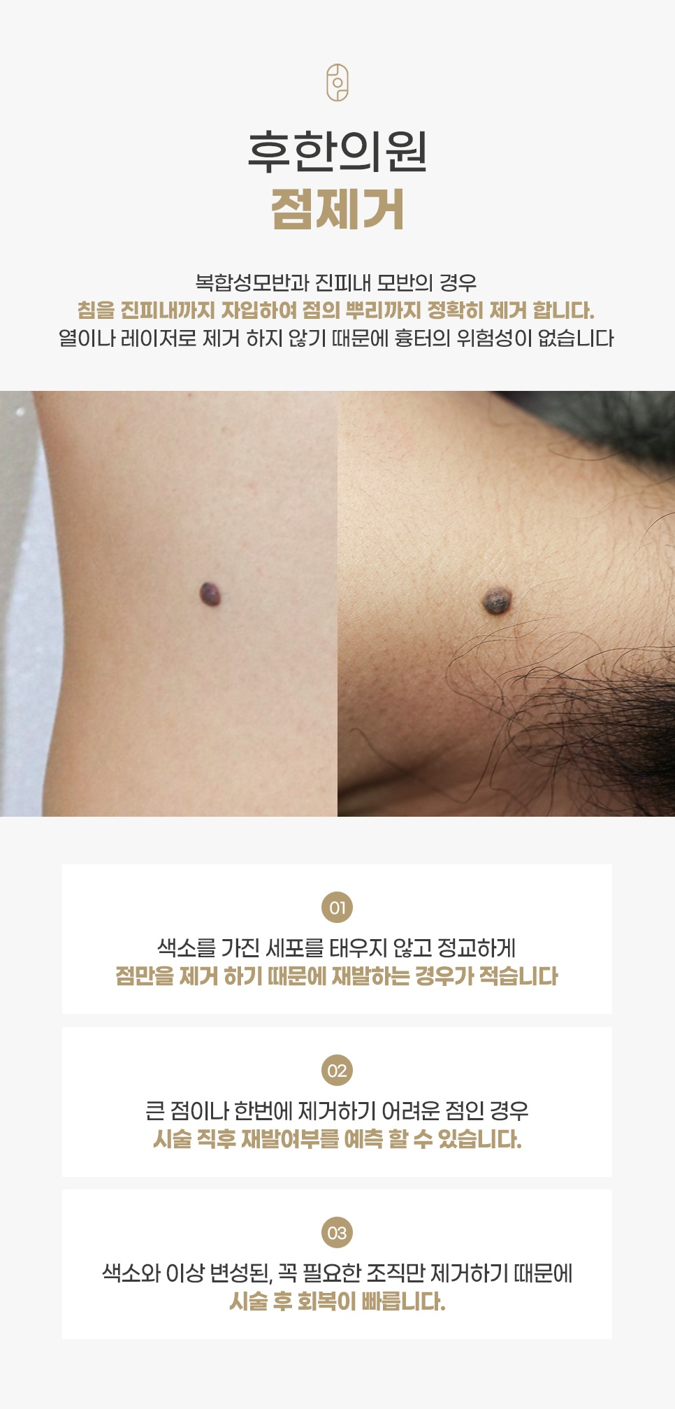 후한의원 점제거 치료 특징