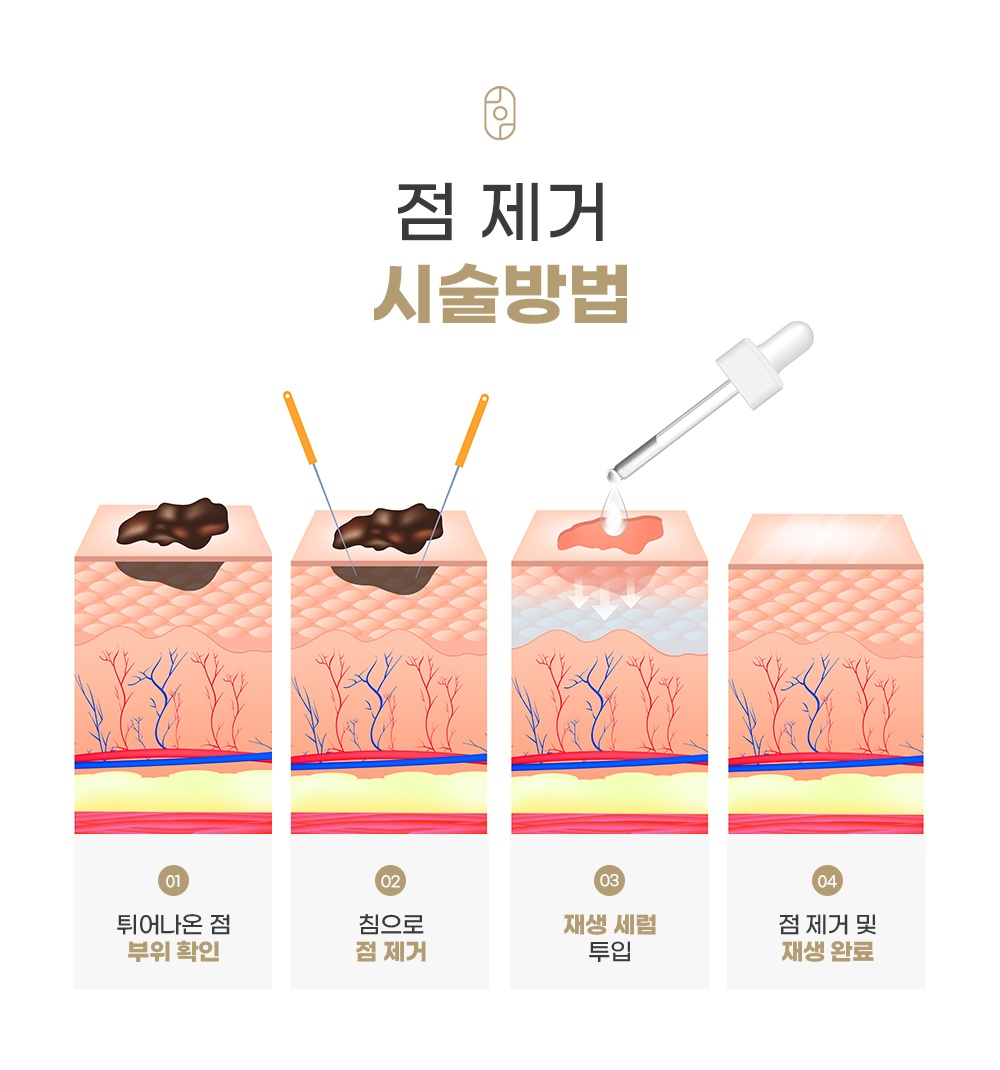 점 제거 시술방법 4단계 과정