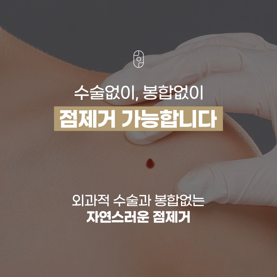 수술 봉합 없이 자연스러운 점제거 시술 안내