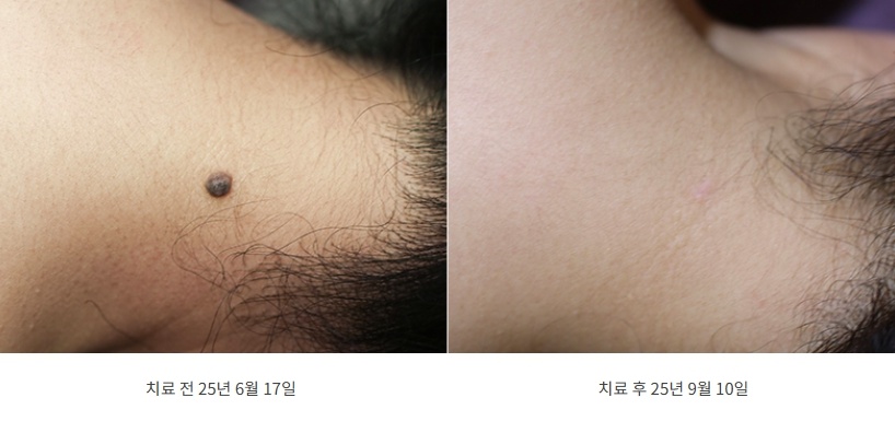 목 점 제거 치료 전후 비교 사진