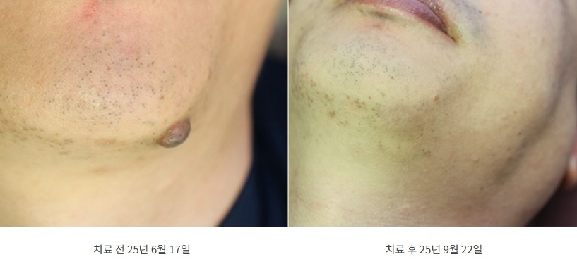 턱 점 제거 치료 전후 비교 사진