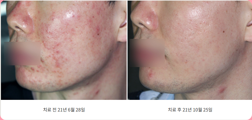 대전습진지루성피부염 볼 부위 병변 치료 전후