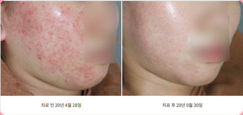 지루성피부염 치료 전후 비교 사진 이미지