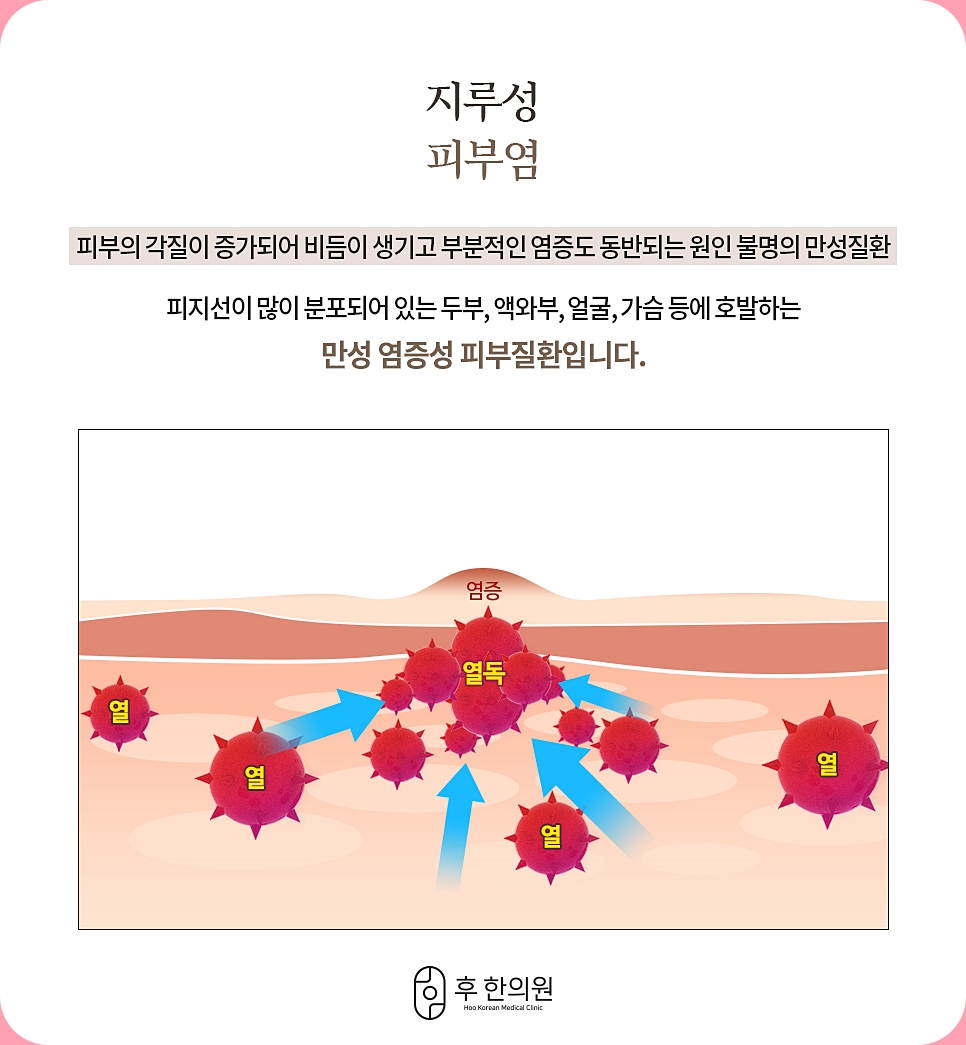 지루성 피부염의 정의에 대한 이미지