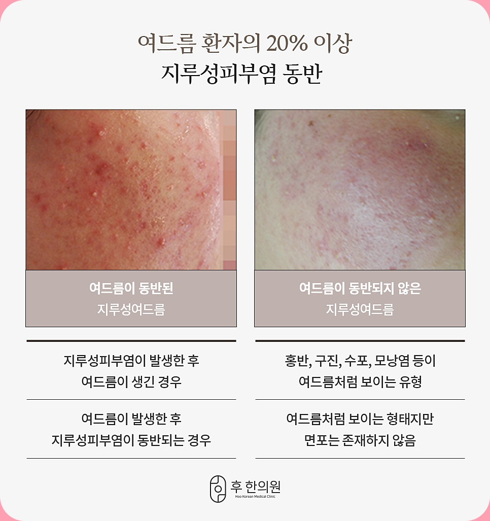 여드름과 지루성피부염의 차이점에 대한 비교 이미지