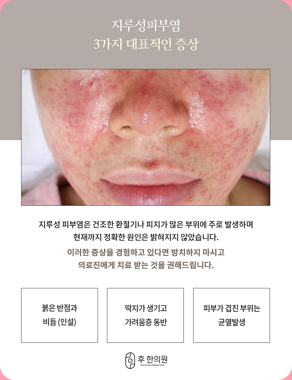 지루성피부염이 얼굴에 나타날 때 대표적 증상