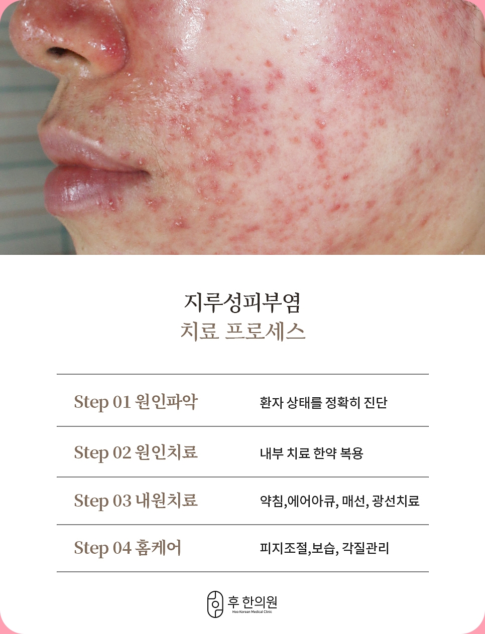 대전습진지루성피부염 후한의원의 치료 프로세스 설명 이미지