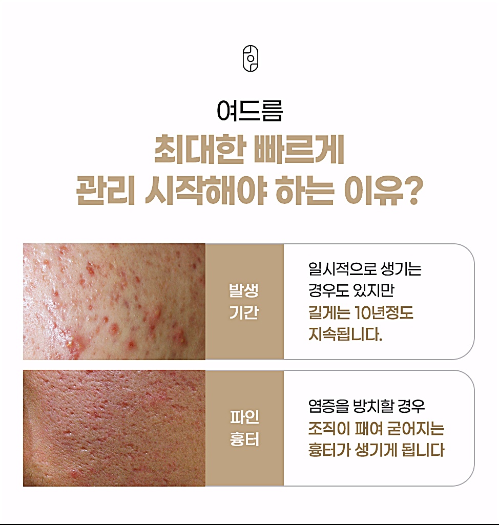 여드름을 방치했을 때 생기는 파인 흉터 위험