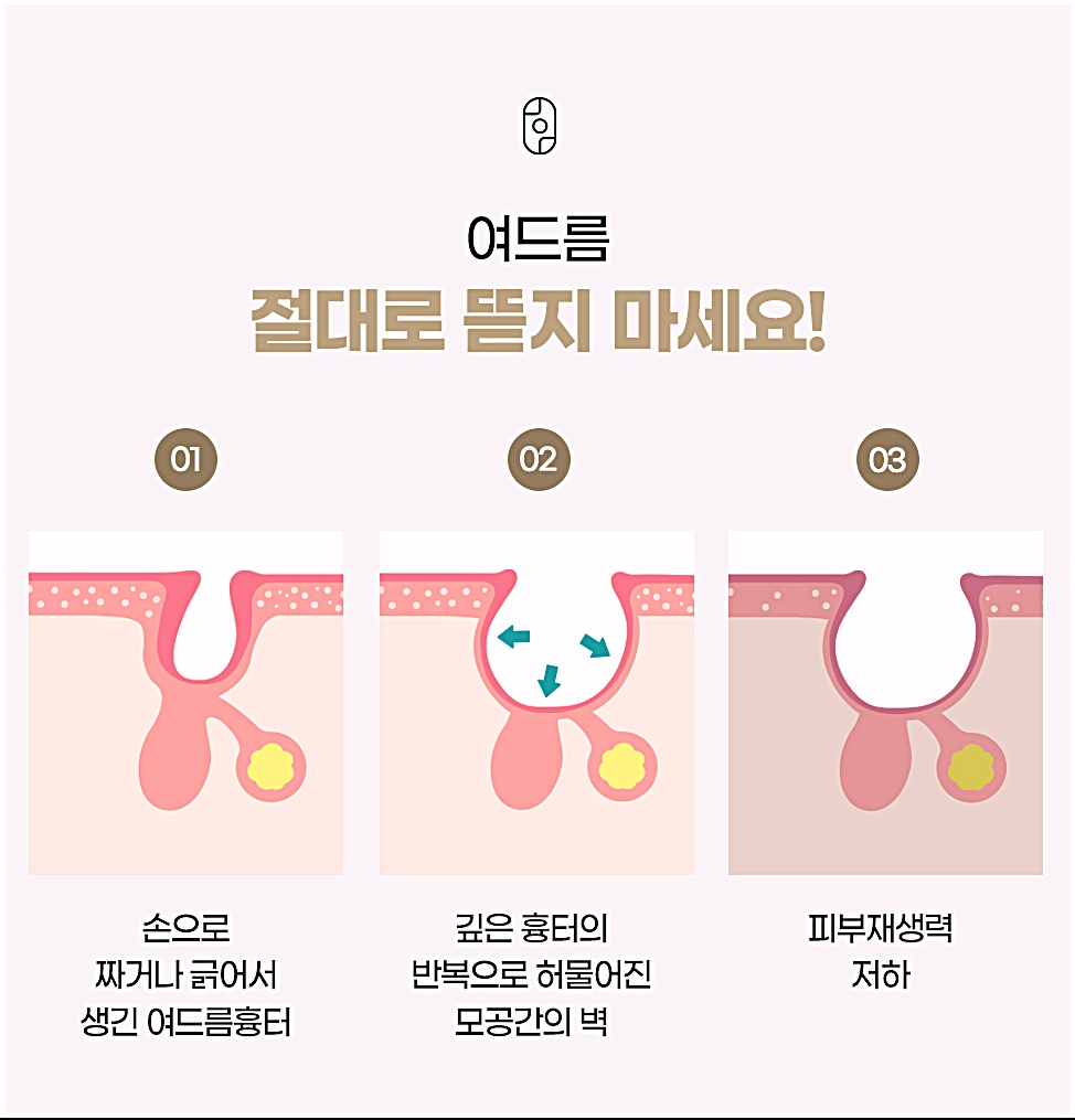 여드름을 손으로 짜거나 긁어서 흉터가 생기는 과정