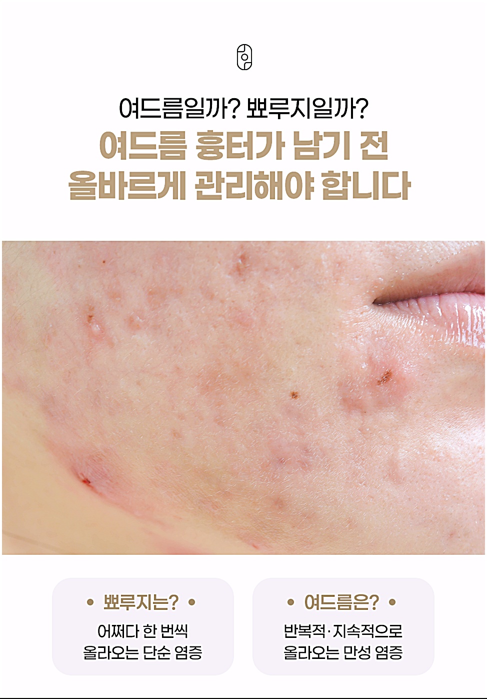 둔산동여드름한의원, 반복되는 여드름과 일시적인 뾰루지의 차이점
