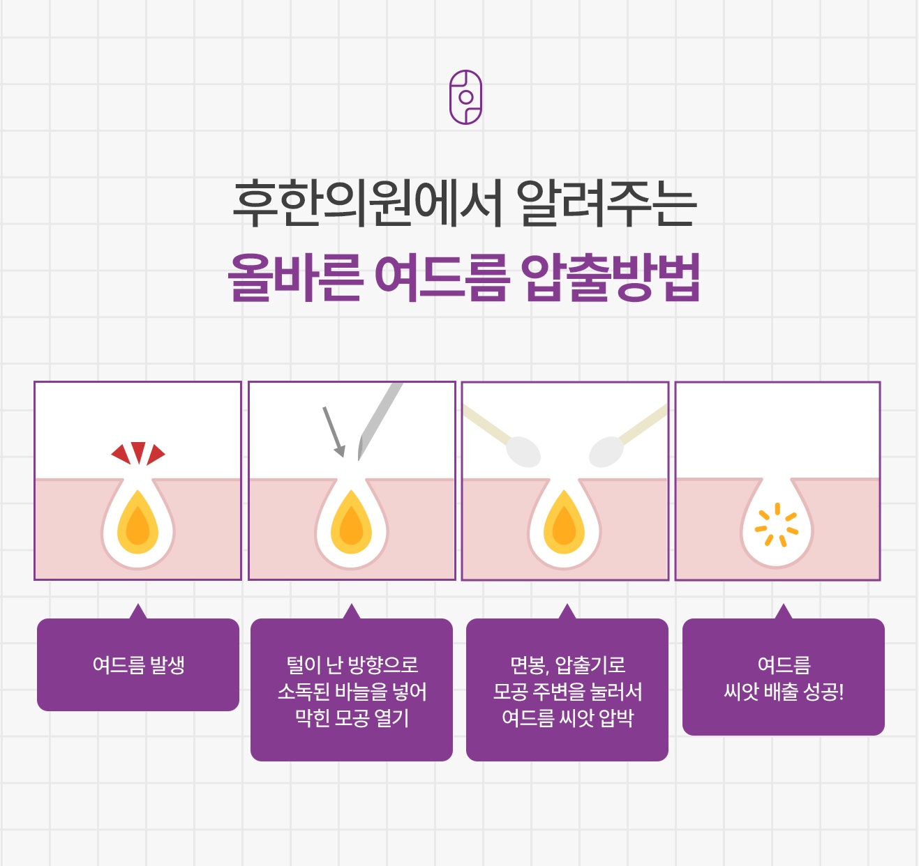 후한의원이 알려주는 올바른 여드름 압출 4단계 방법