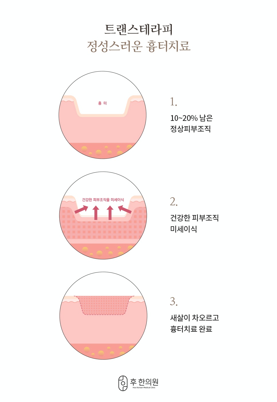 후한의원 트랜스테라피 건강한 피부조직 미세이식 3단계 원리