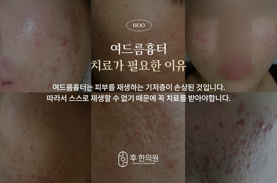 여드름흉터 치료가 필요한 이유 - 기저층 손상과 재생 안내