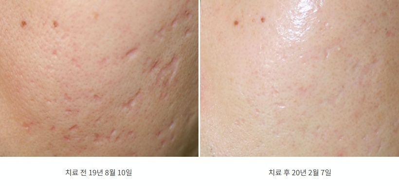 여드름 패인 흉터 트랜스테라피 치료 전후 비교 사진