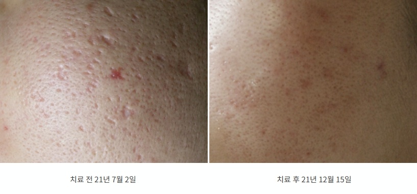 모공성 및 여드름 흉터 개선 전후 비교 사진