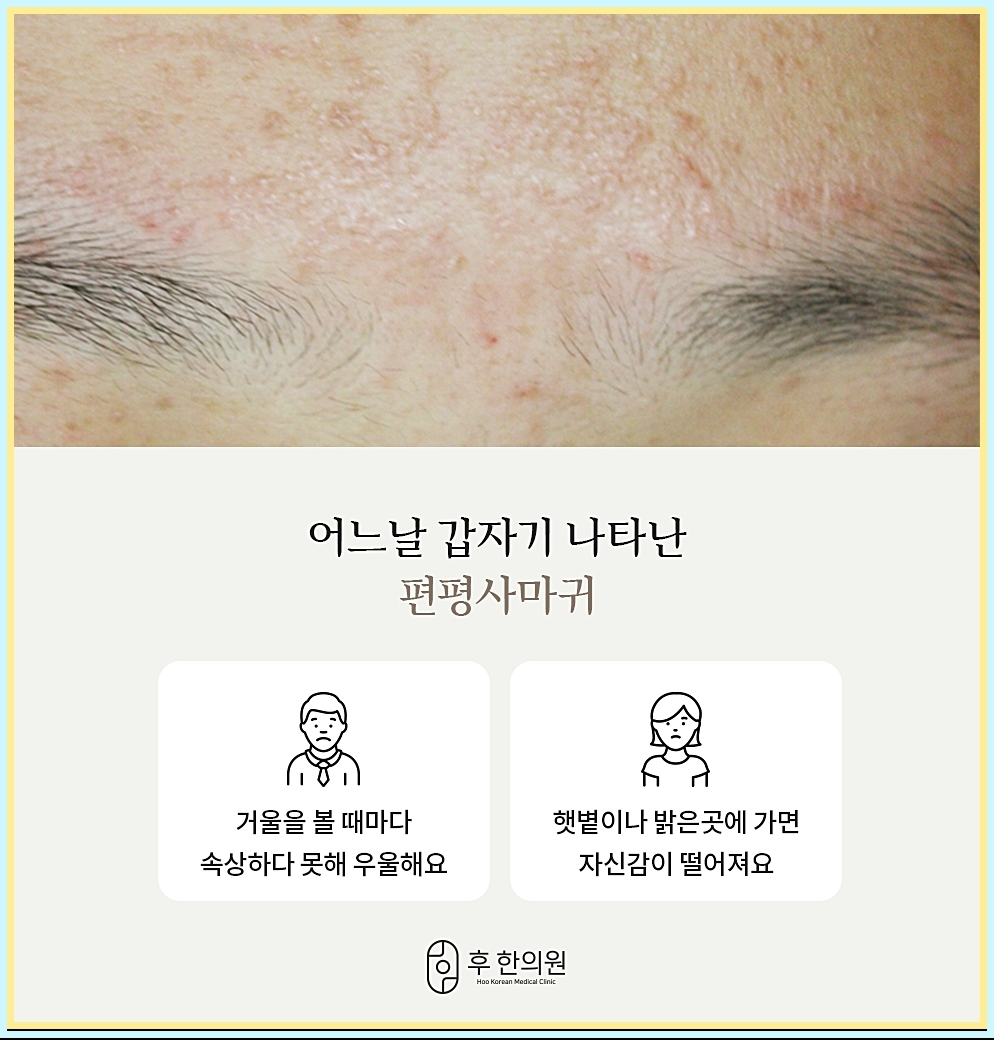어느날 나타난 편평사마귀 원인 이미지