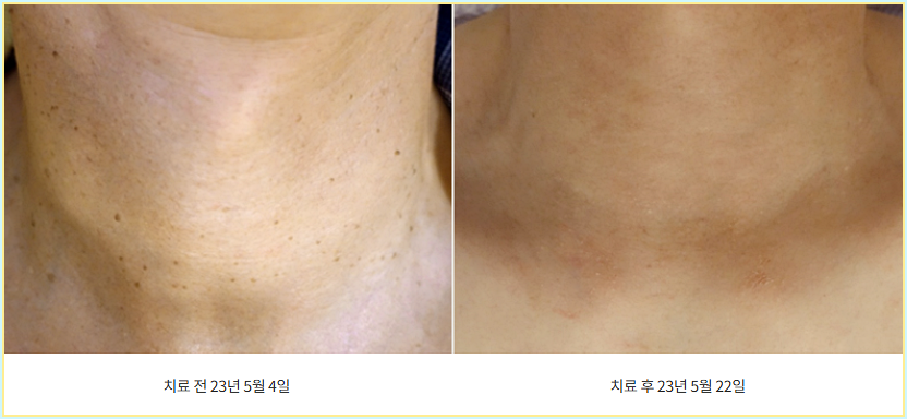 목 편사 제거 전후