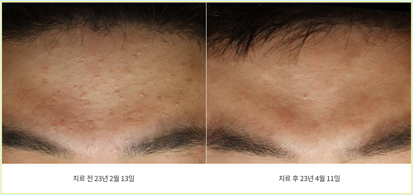 이마 편사 제거 전후