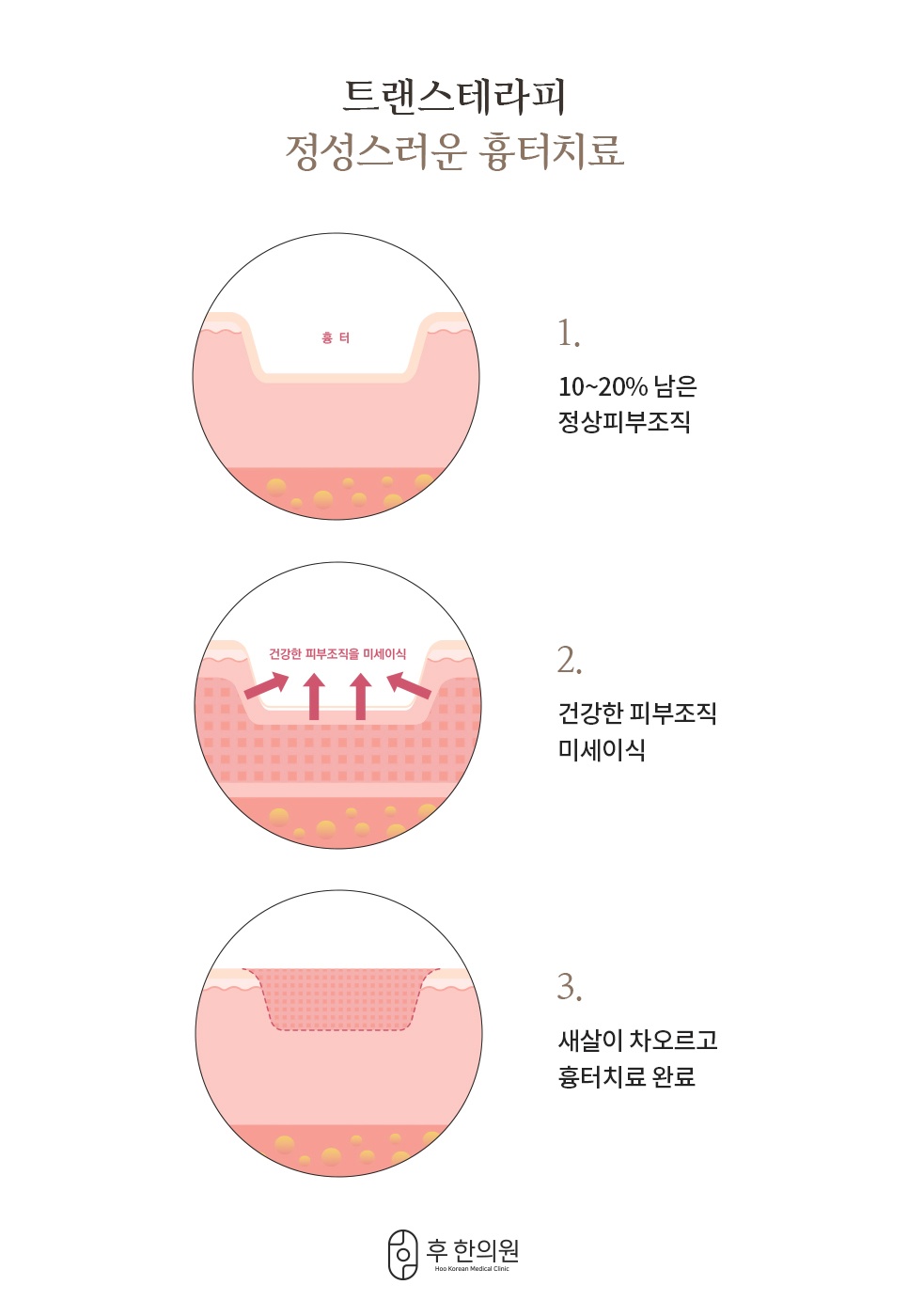 트랜스테라피 여드름 흉터 피부 조직 미세이식 치료 원리 3단계
