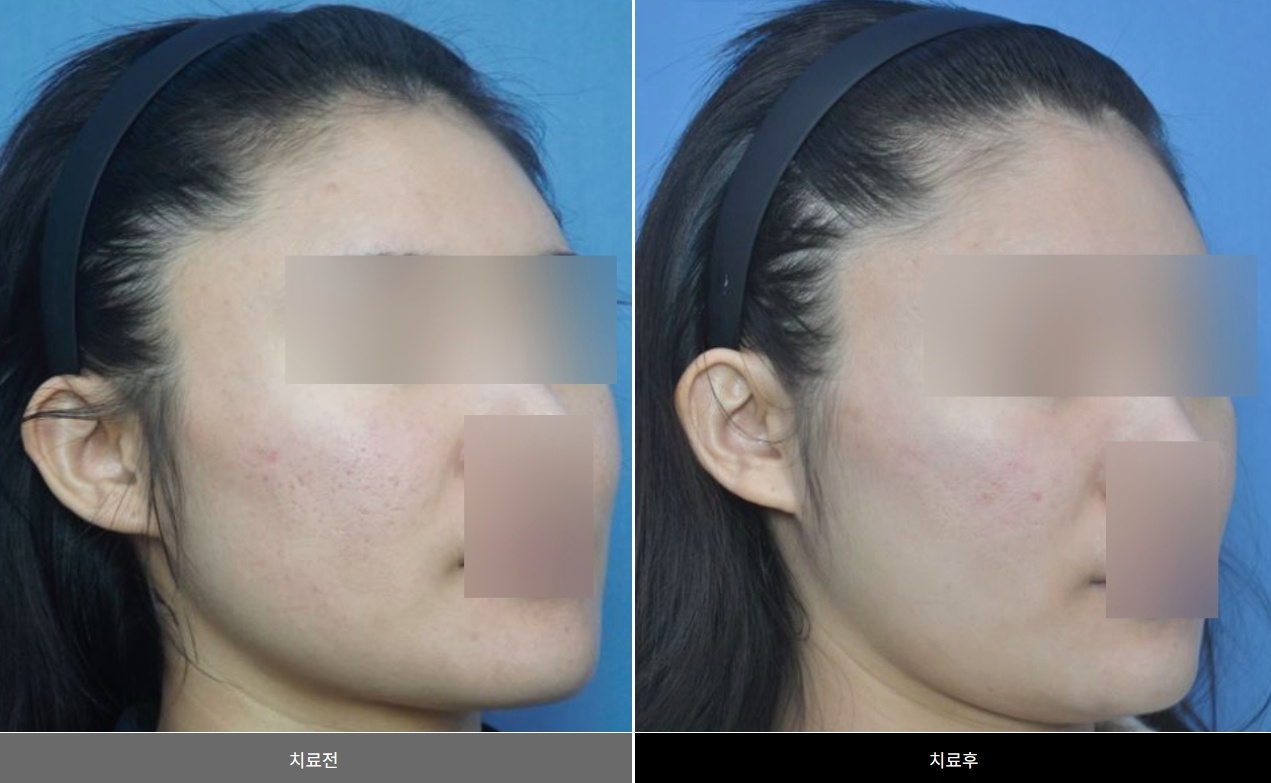 여드름 흉터 트랜스테라피 시술 전후 비교 사진