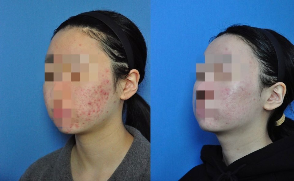 볼과 턱 쪽 붉은 여드름이 줄어든 치료 전후 비교 사진