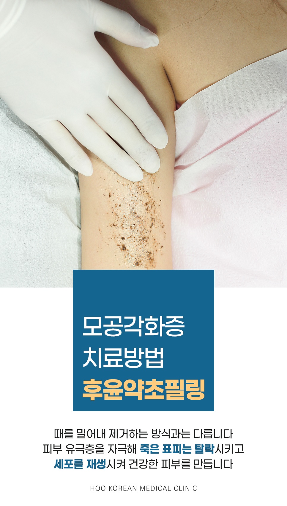 때밀이와 달리 유극층을 자극해 죽은 표피를 탈락시키는 팔 후윤약초필링 시술 장면