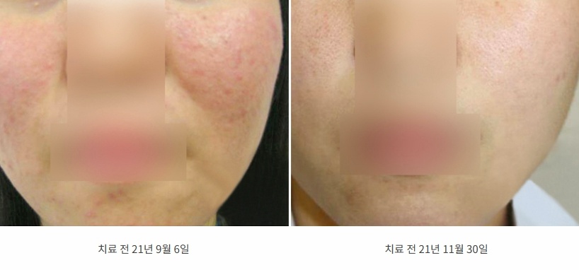 양볼 붉은기가 가라앉은 21년 9월과 11월 전후 비교