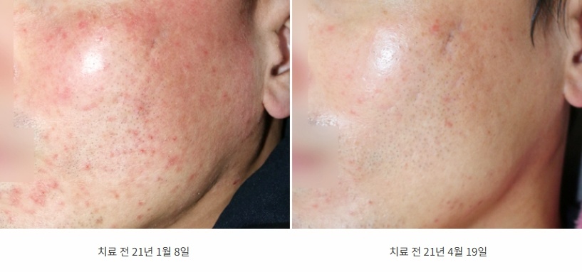 볼과 턱선 붉은 자국이 옅어진 21년 1월과 4월 전후 비교