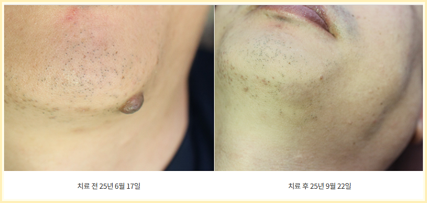 대전점빼기 제거 전후 사진