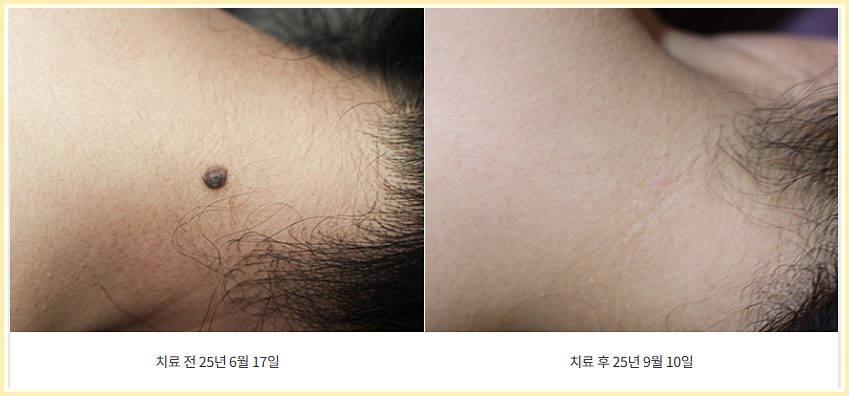 목뒤 점 제거 전후 사진