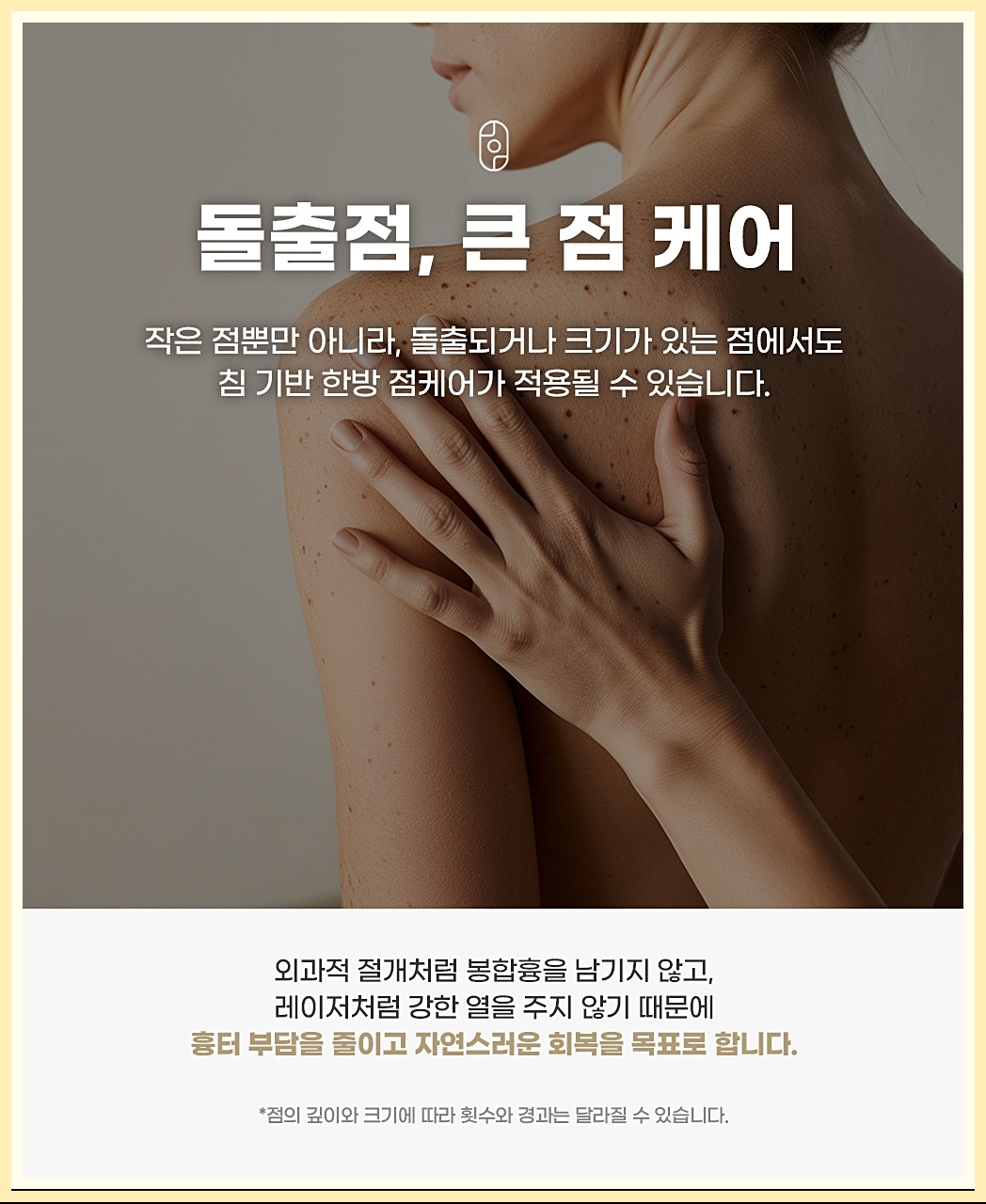대전점빼기 시술의 특징