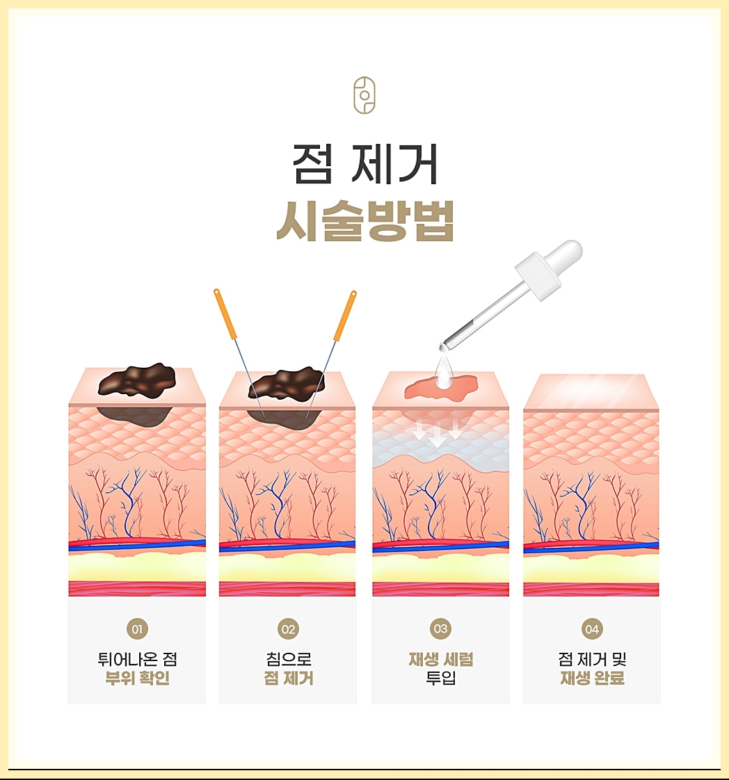 점제거 시술 방법 정리