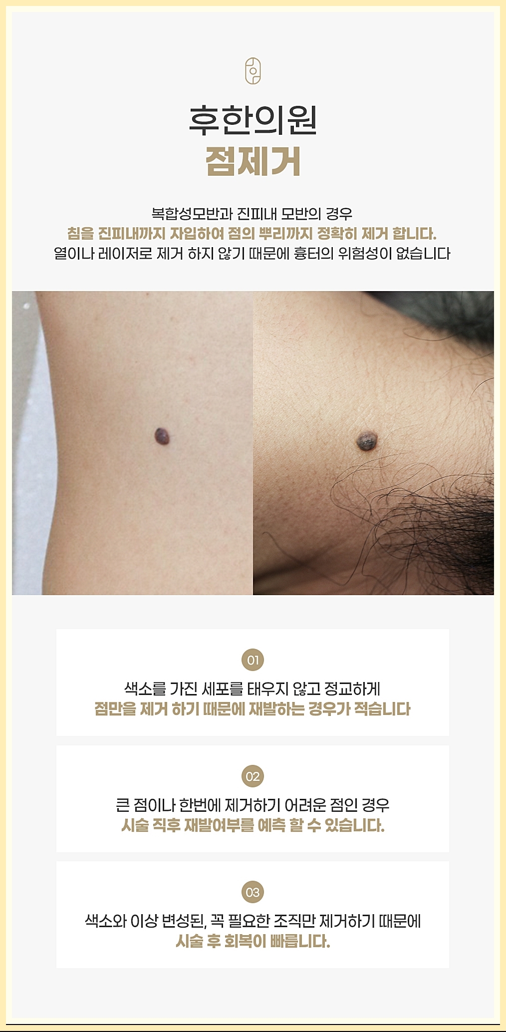 점제거 한의원 시술 특징