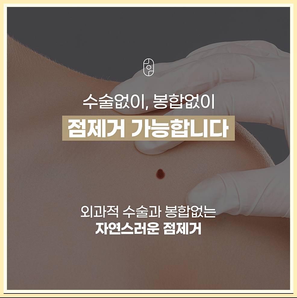 점제거의 특징
