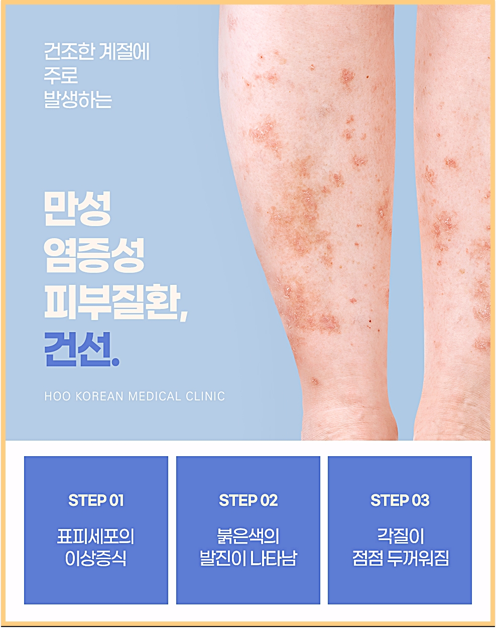 대전건선습진 건조한 계절에 주로 발생하는 만성 염증성 피부질환 건선