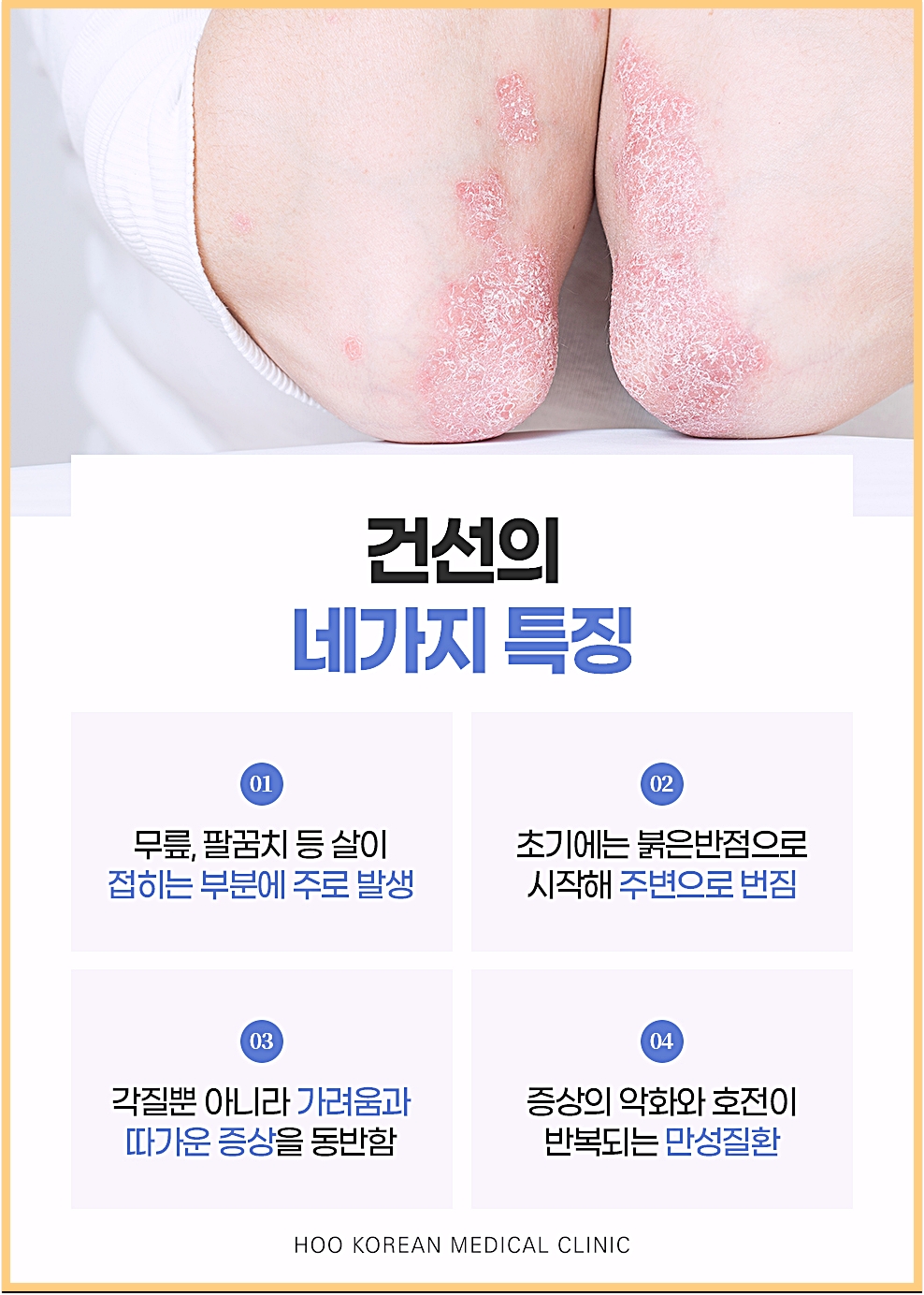 무릎과 팔꿈치 부위의 붉은 반점과 각질을 보여주는 건선의 네 가지 특징