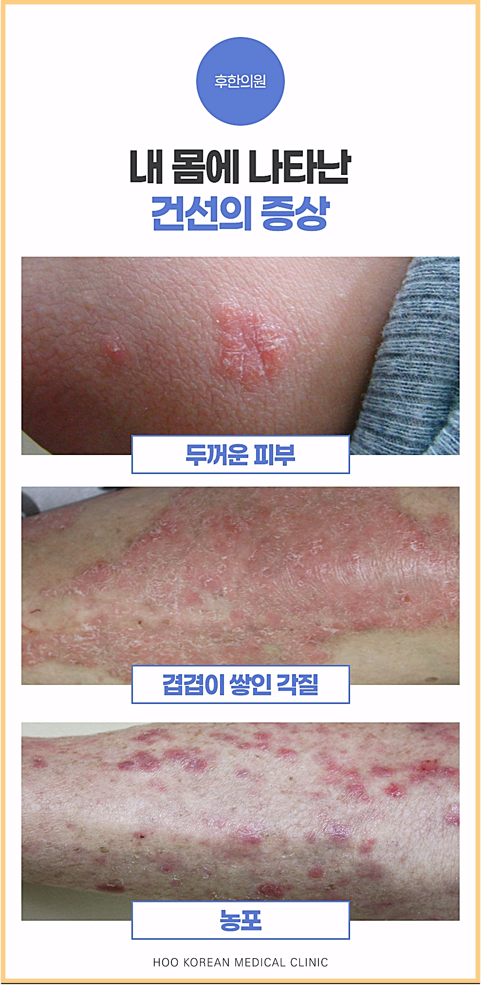 대전건선습진 두꺼운 피부, 겹겹이 쌓인 각질, 농포 등 건선 증상 유형