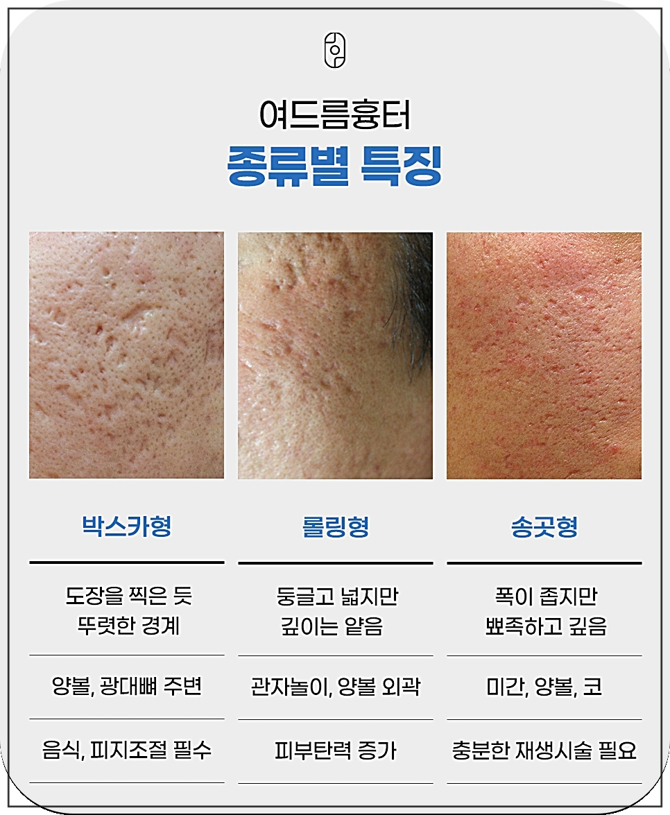대전새살침 여드름 흉터의 종류