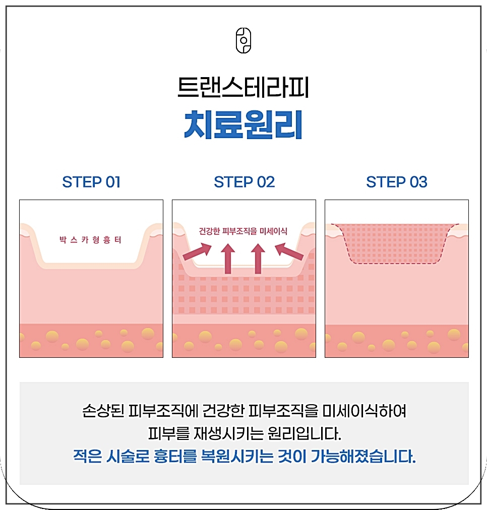 트랜스테라피의 구체적인 치료 원리 설명