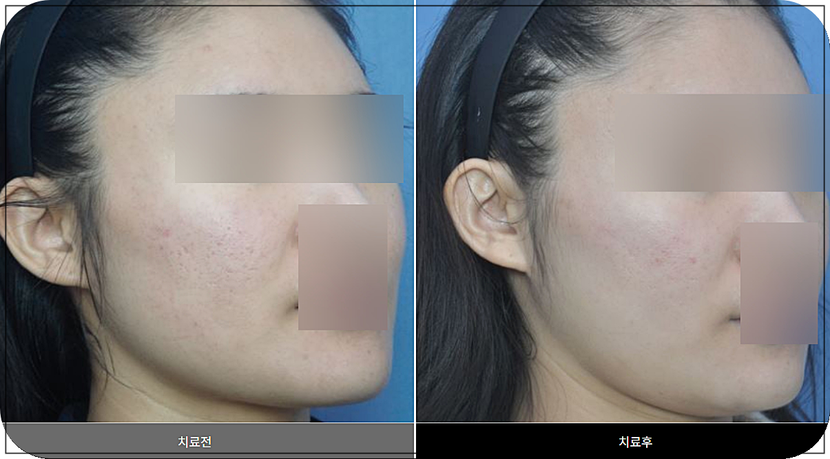 대전새살침 시술 전후
