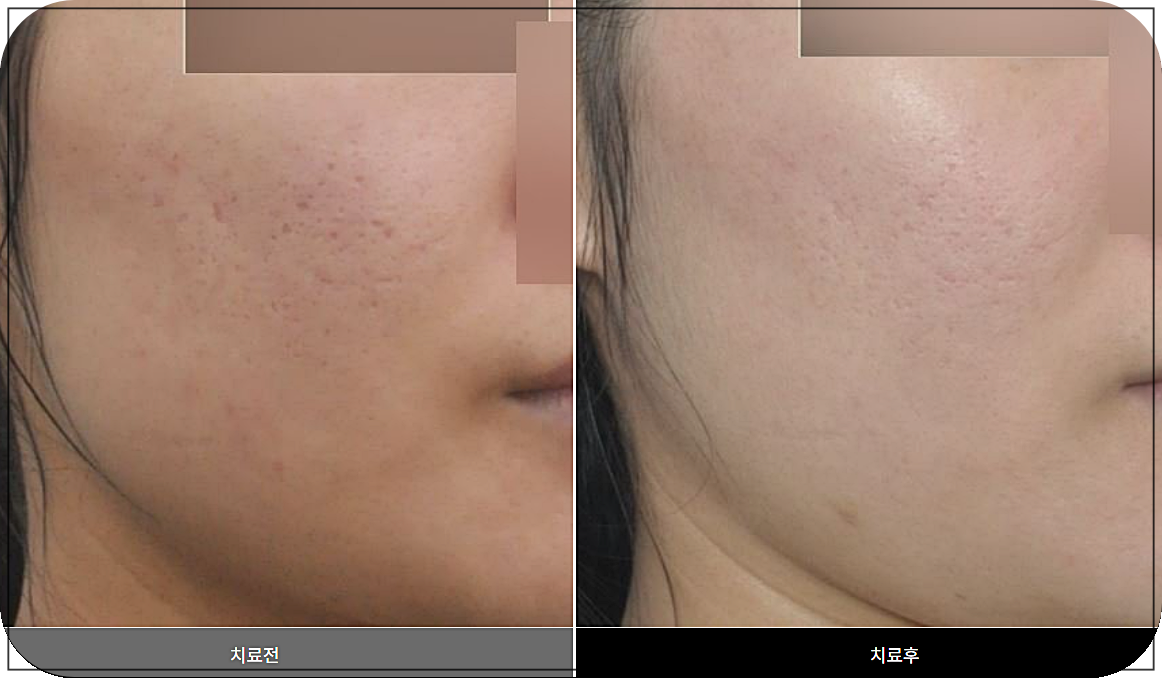 볼 부분 새살침 치료 전후