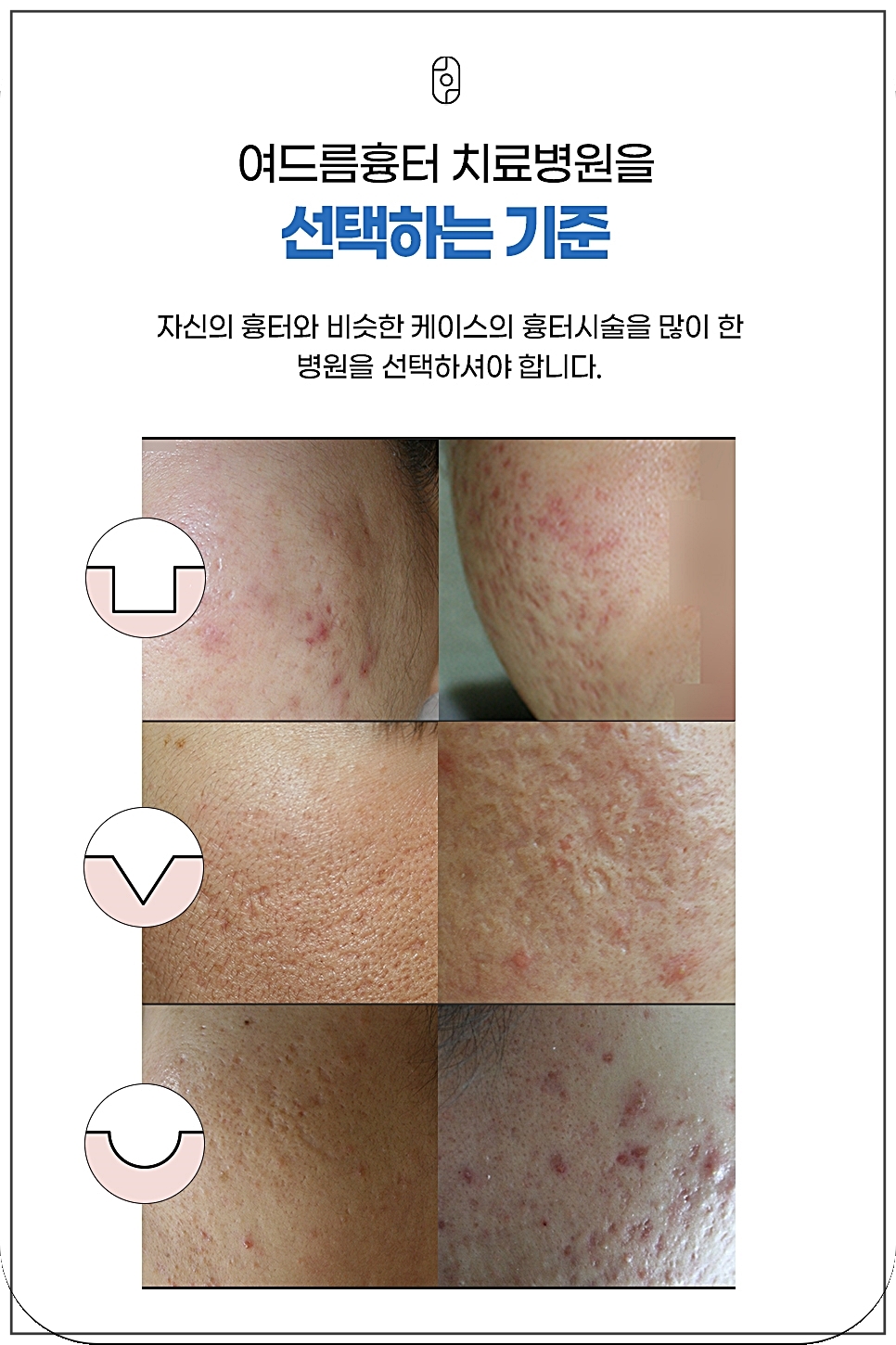 여드름 흉터 병원 선택의 기준 정리