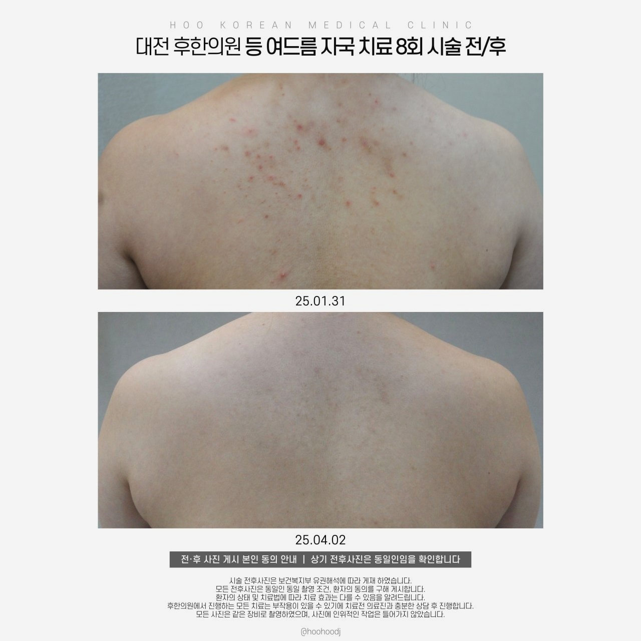 대전 등여드름 치료 8회 전후