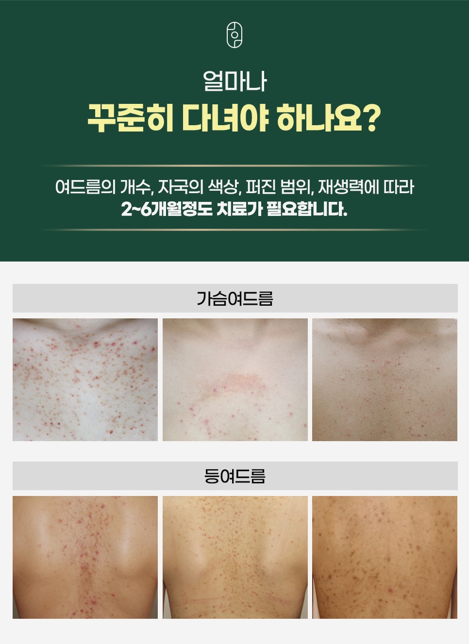 대전등여드름 치료 기간 2~6개월