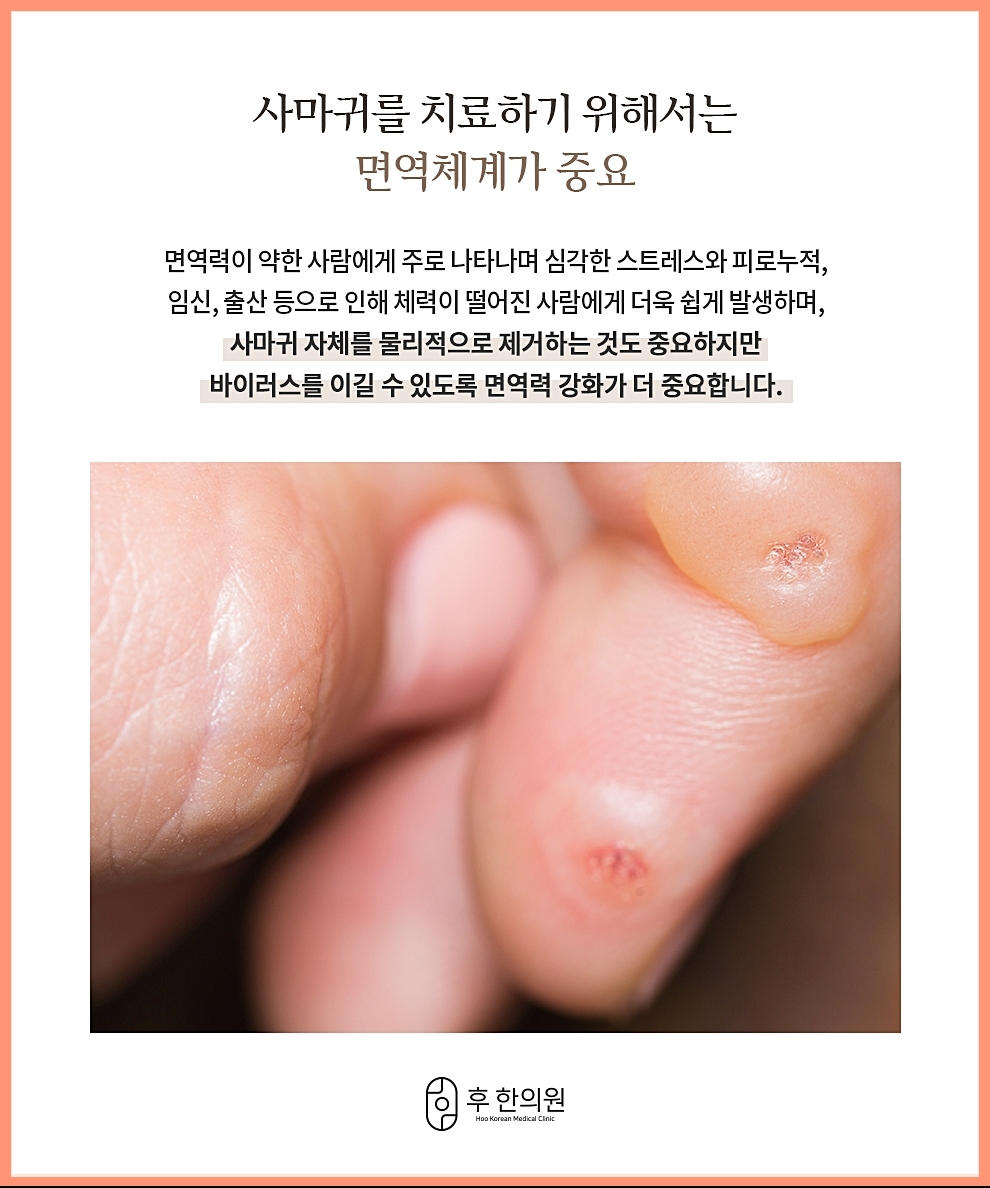 편평사마귀 치료에 핵심 키워드가 되는 면역체계